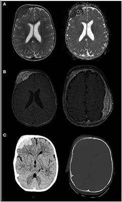 Case Report: The Value of Genomic Analysis in a Case of Megakaryoblastic Leukemia With Atypical Initial Manifestation